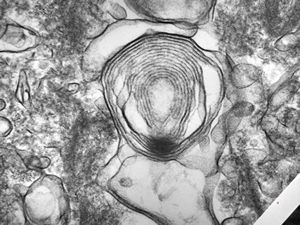 M,22y. | alveolar macrophage … phagocytosed surfactant